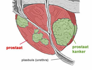 cáncer de próstata