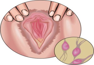 tricomoniasis